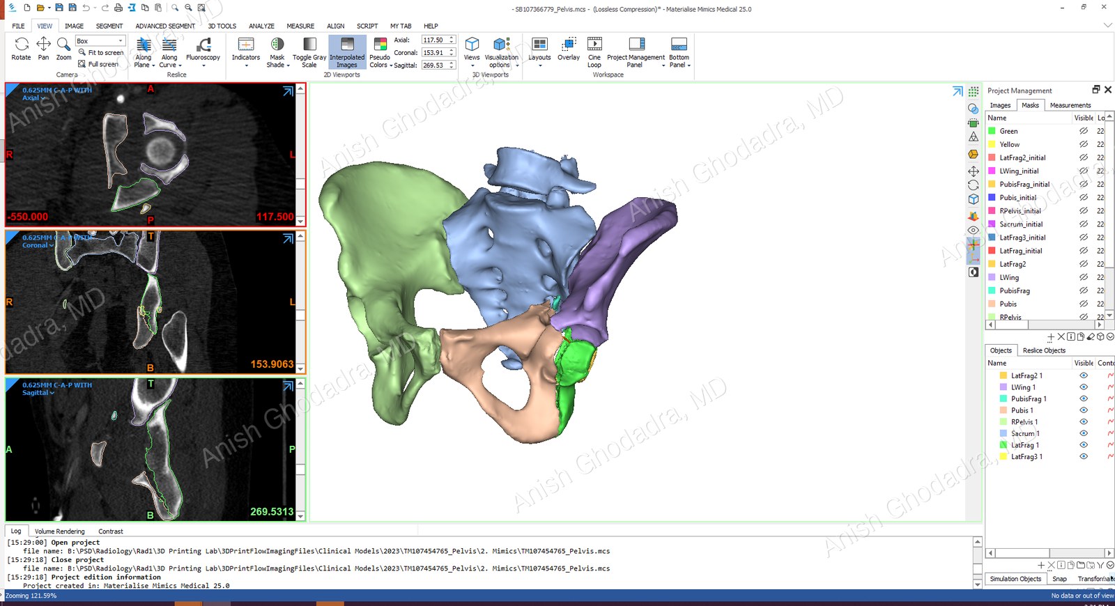 3D printing segmentation software showing CT slices alongside a color-coded three-dimensional model of the pelvis