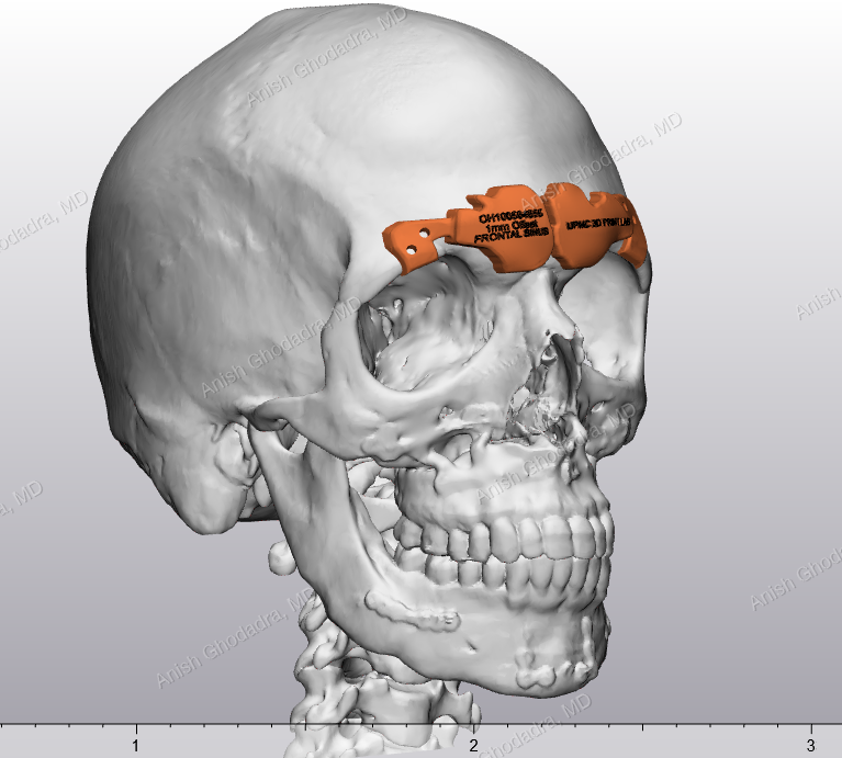 A digital model of a skull with a patient-specific orbital cutting guide positioned for surgical planning