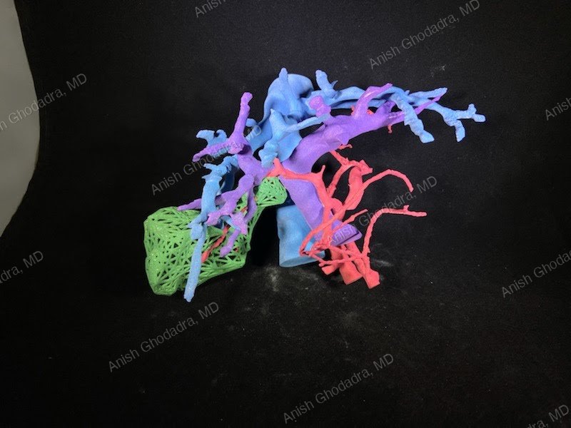 A full-color 3D-printed anatomic model of vascular and organ structures produced by the UPMC 3D Printing Program