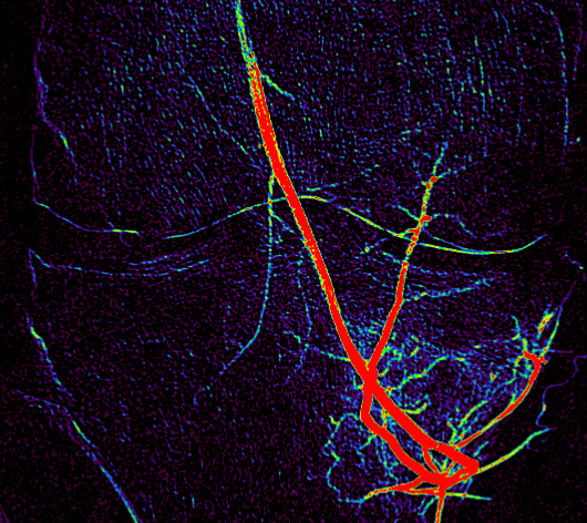 The same view after embolization, with the bright cluster of abnormal vessels gone