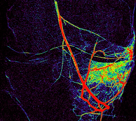 Color-coded blood flow map of a knee before embolization, showing a bright cluster of abnormal vessels feeding the inflamed joint lining
